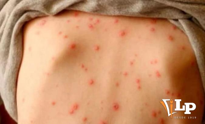 Sarpullido del sarampión